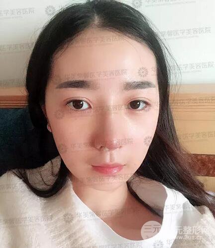 四川成都华美艾玉峰隆鼻修复案例术后恢复图