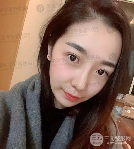 四川成都华美艾玉峰隆鼻修复案例术后恢复图