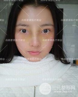 成都素美假体隆鼻案例前后对比图分享!