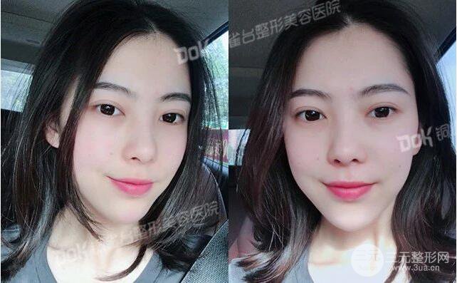 重庆铜雀台玻尿酸注射填充案例图片