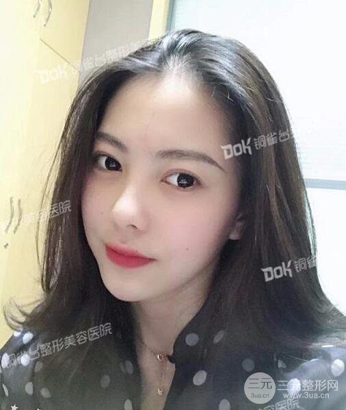 重庆铜雀台玻尿酸注射填充案例图片