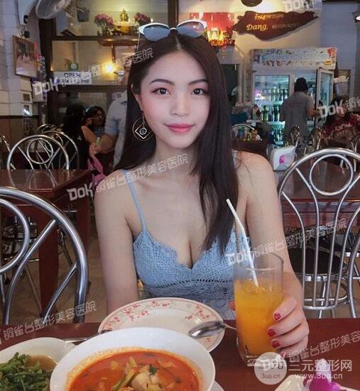 重庆铜雀台假体隆胸案例恢复果图