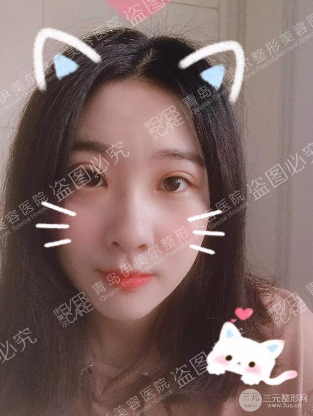 青岛伊美尔双眼皮恢复实记案例对比图分享