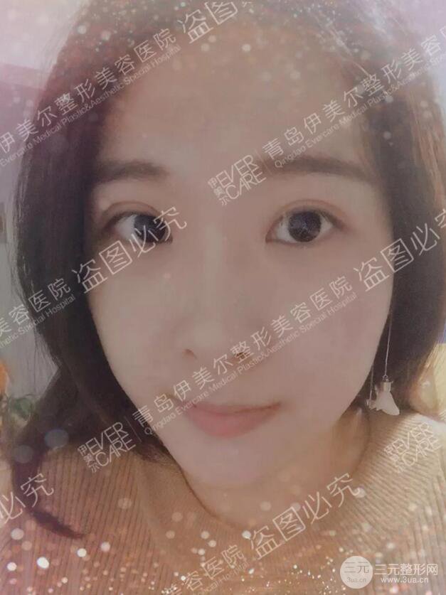 青岛伊美尔双眼皮恢复实记案例对比图分享