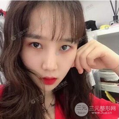 上海华美李志海隆鼻整形案例前后对比图分享~