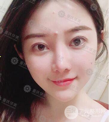 重庆华美何春涛假体隆鼻案例过程恢复分享