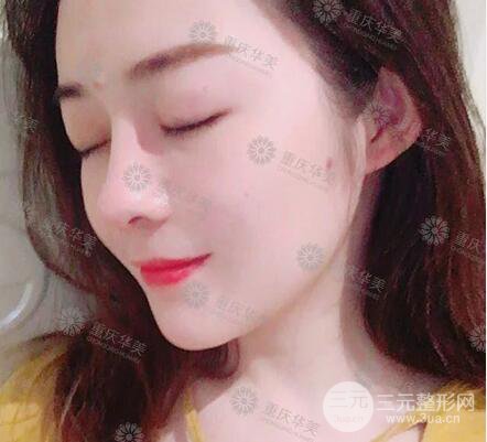 重庆华美何春涛假体隆鼻案例过程恢复分享