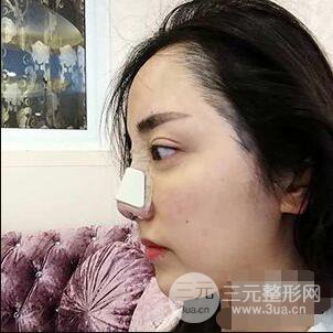 杭州格莱美张树功假体隆鼻前后对比图|内附恢复心情变化哦