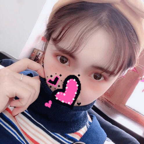 扬州艾菲斯黄婵双眼皮案例术后恢复果