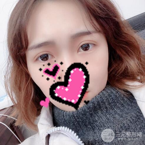 扬州艾菲斯黄婵双眼皮案例术后恢复果