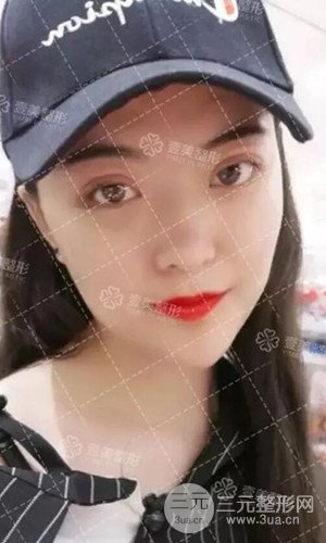 淄博壹美切开双眼皮案例分享！附上恢复过程图~