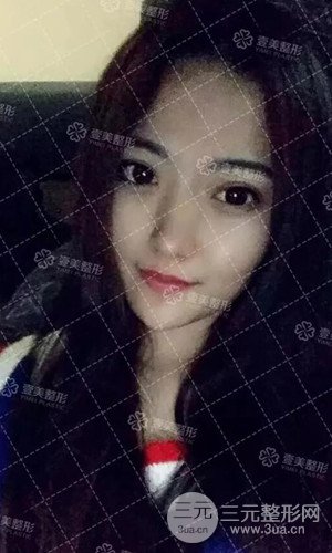 淄博壹美切开双眼皮案例分享！附上恢复过程图~
