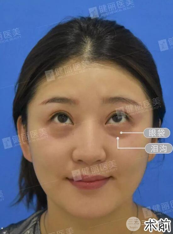 深圳健丽微创去眼袋+眶隔脂肪转移术前后对比果图分享！