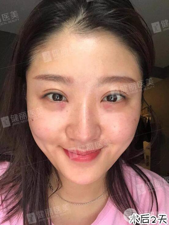 深圳健丽微创去眼袋+眶隔脂肪转移术前后对比果图分享！
