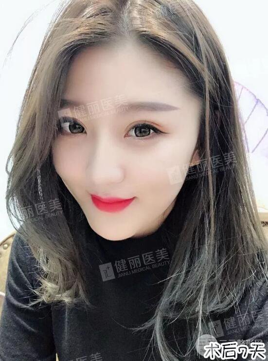 深圳健丽微创去眼袋+眶隔脂肪转移术前后对比果图分享！