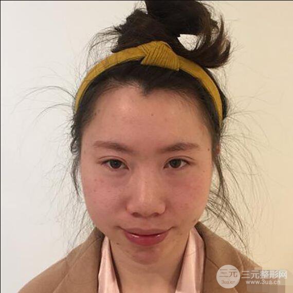 北京联合丽格吴焱秋耳软骨隆鼻前后对比图|塌鼻子的救星