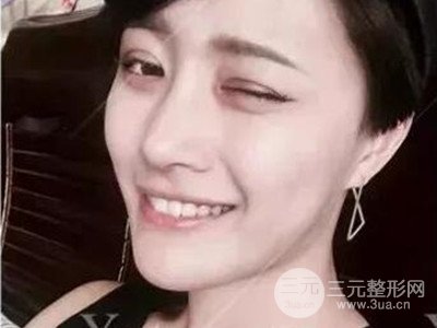 成都艺星切开双眼皮+隆鼻整形日记分享