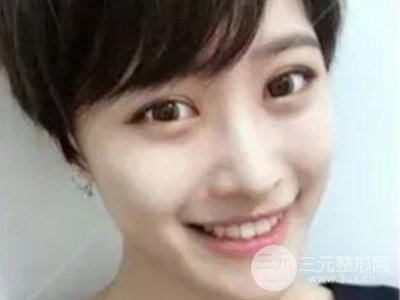 成都艺星切开双眼皮+隆鼻整形日记分享