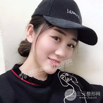 沈阳百嘉丽隆鼻整形前后恢复图记录分享~