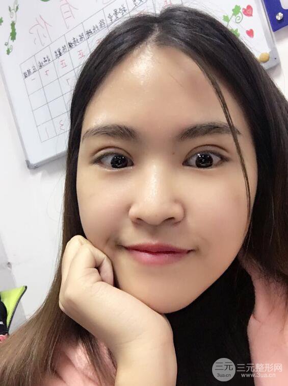 沈阳百嘉丽叶微微切开双眼皮前后对比图恢复心情小札