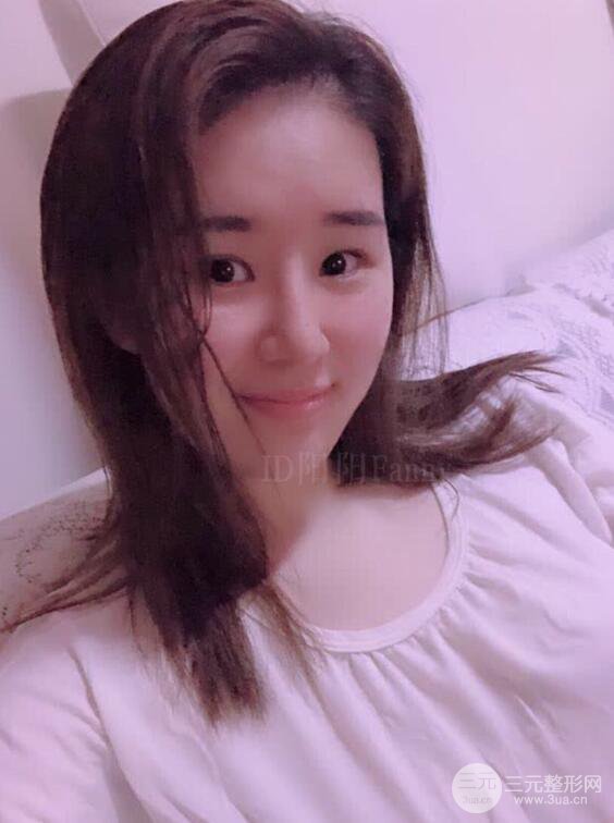 上海华美李庭勋假体隆鼻前后对比图一个月恢复心情日记