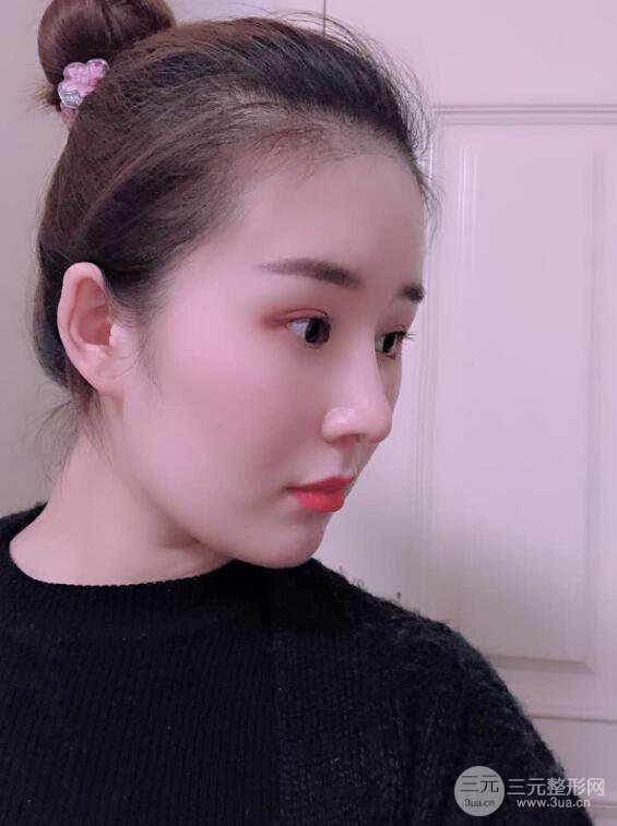 上海华美李庭勋假体隆鼻前后对比图一个月恢复心情日记