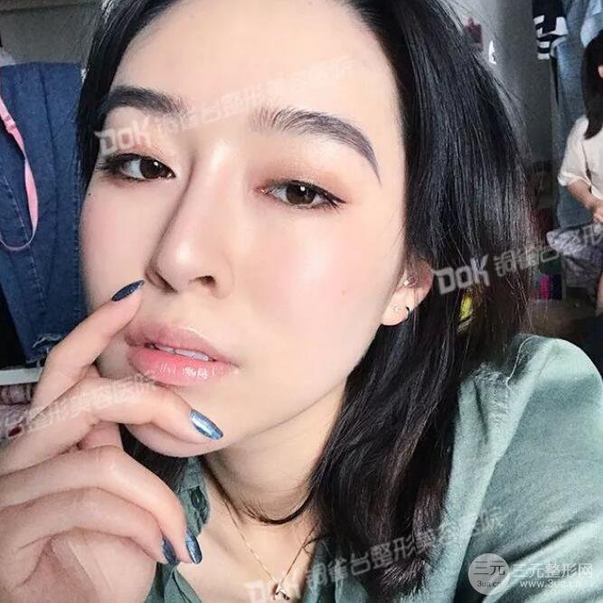 重庆铜雀台假体隆鼻前后对比图案例分享!
