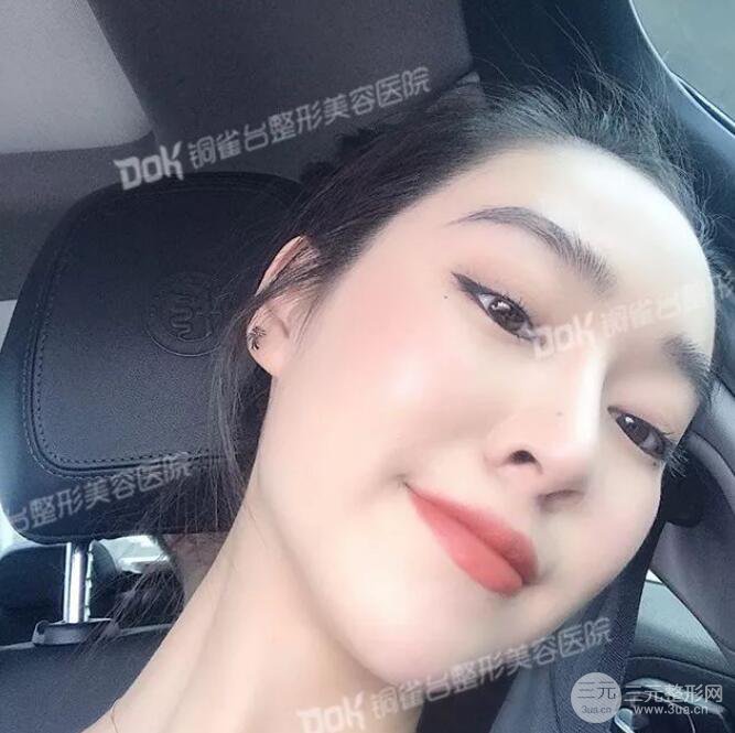 重庆铜雀台假体隆鼻前后对比图案例分享!