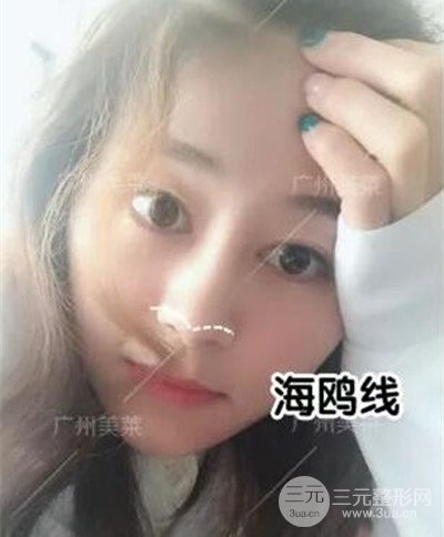 广州美莱自体软骨隆鼻案例前后对比图分享!