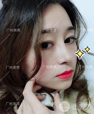 广州美莱自体软骨隆鼻案例前后对比图分享!