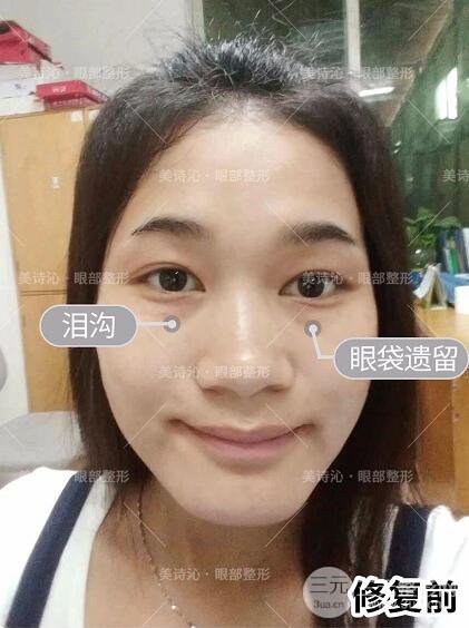 北京诗美沁祛眼袋案例术后果分享！