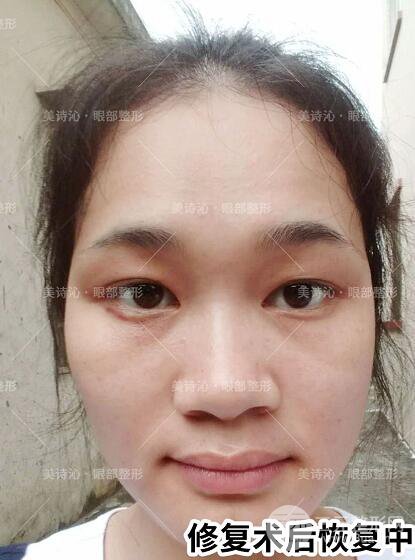 北京诗美沁祛眼袋案例术后果分享！