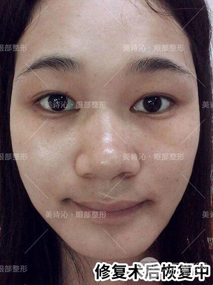 北京诗美沁祛眼袋案例术后果分享！