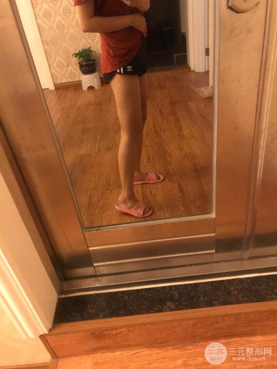 德阳东美奥克拉杨华博大腿吸脂前后对比图 四个月恢复变化小记