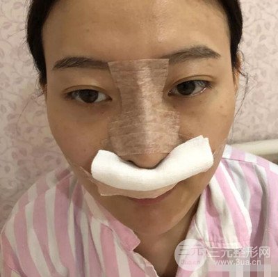 南京华美隆鼻整形前后对比图分享
