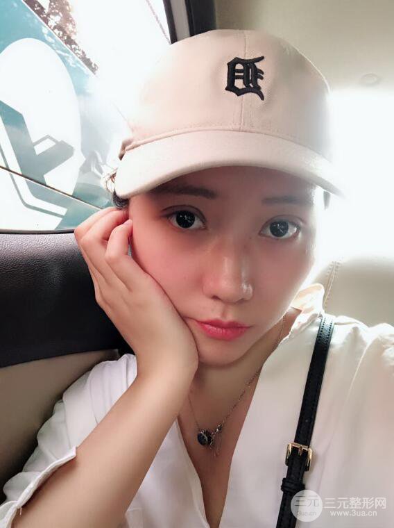 哈医大二院整形科肖志波全切双眼皮前后对比图 真实恢复经历日记