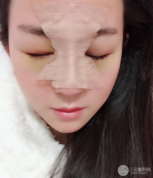 杭州华山连天美高俊明假体隆鼻术前术后对比图 两个月恢复心情