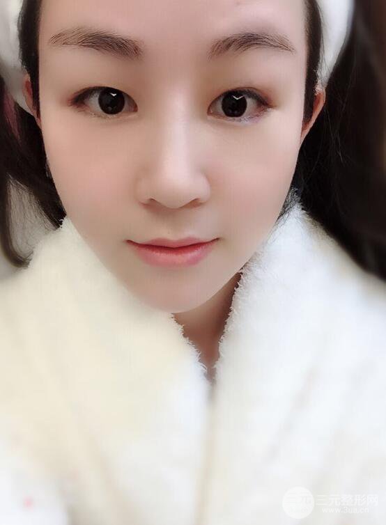 杭州华山连天美高俊明假体隆鼻术前术后对比图 两个月恢复心情