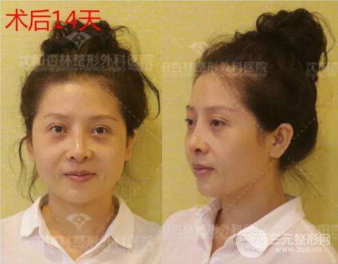 沈阳杏林朱石江隆鼻隆鼻整形案例手术过程记录