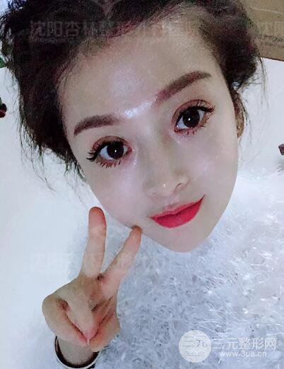 沈阳杏林朱石江隆鼻隆鼻整形案例手术过程记录