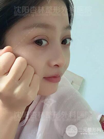 沈阳杏林朱石江隆鼻隆鼻整形案例手术过程记录