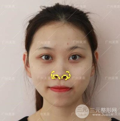 广州美莱隆鼻整形+自体脂肪填充面部前后对比图以及恢复过程分享