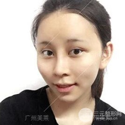 广州美莱隆鼻整形+自体脂肪填充面部前后对比图以及恢复过程分享