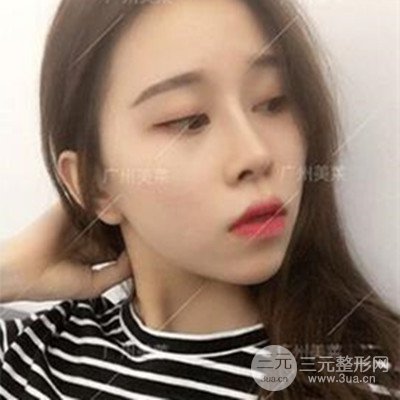 广州美莱隆鼻整形+自体脂肪填充面部前后对比图以及恢复过程分享