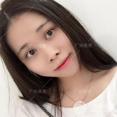 广州美莱隆鼻整形+自体脂肪填充面部前后对比图以及恢复过程分享