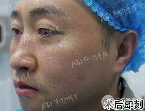北京诗美沁祛眼袋案例，男士微创祛眼袋果分享！