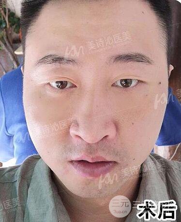 北京诗美沁祛眼袋案例，男士微创祛眼袋果分享！