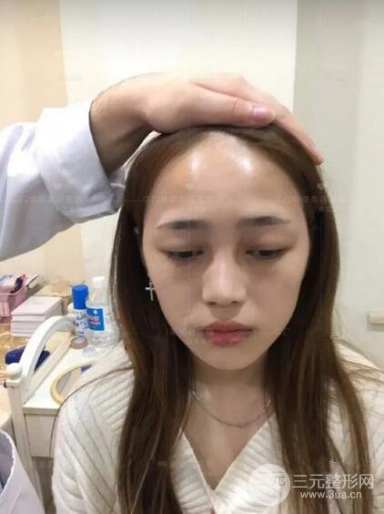 重庆爱思特整形隆鼻案例术后恢复果分享！