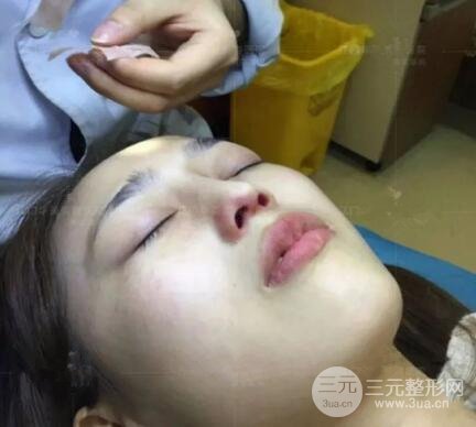 重庆爱思特整形隆鼻案例术后恢复果分享！