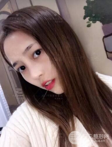 重庆爱思特整形隆鼻案例术后恢复果分享！